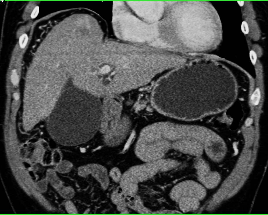 2 cm Hepatocellular Carcinoma (Hepatoma) Dome of Liver - CTisus CT Scan