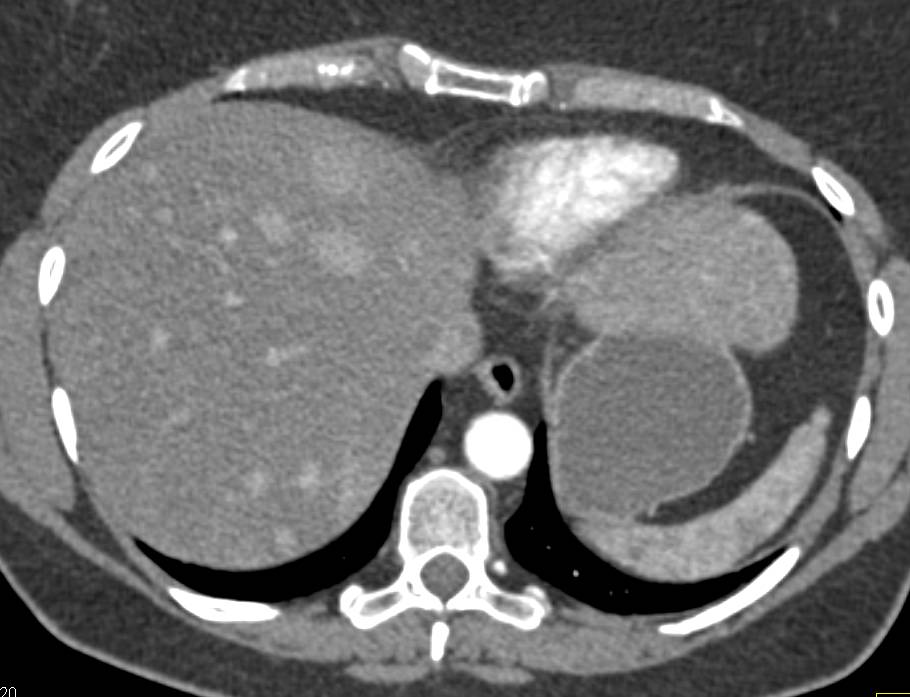 Metastatic Carcinoid Tumor to the Liver with Spontaneous Hepatic Bleed - CTisus CT Scan