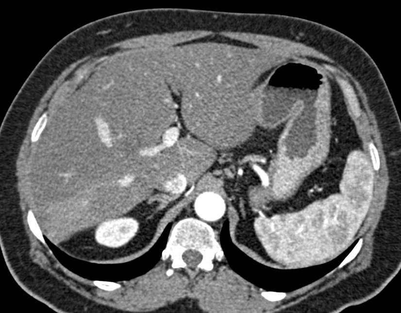 Solitary Metastases to Right Lobe Liver with Perfusion Changes on Arterial Phase Accentuated by Diffuse Fatty Infiltration of the Liver - CTisus CT Scan