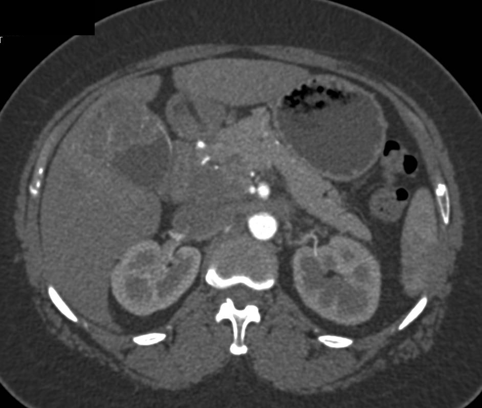 Gallbladder Cancer with Extension to Port with Nodes in Portocaval Space as well as Portal Vein Encasement - CTisus CT Scan