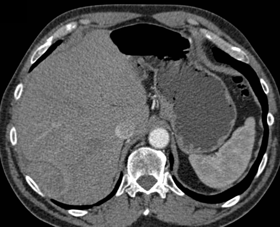 Subcapsular Bleed Following Liver Biopsy - CTisus CT Scan