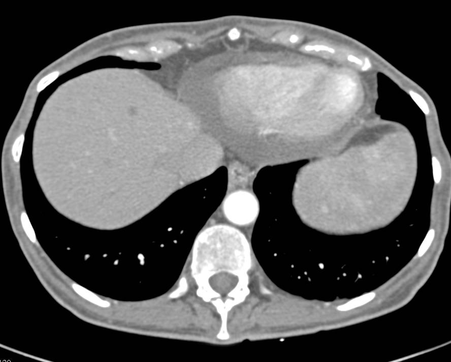 Candidiasis in Liver and Spleen in an Immunosuppressed Patient - CTisus CT Scan