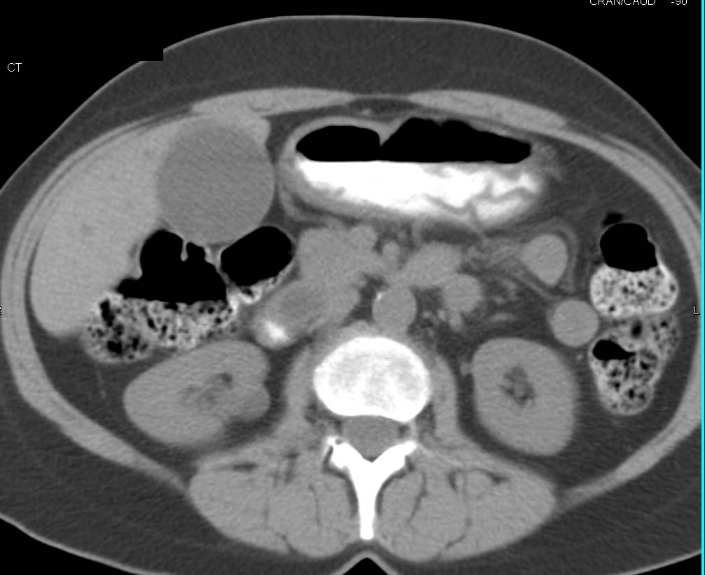 Ampullary Carcinoma - CTisus CT Scan