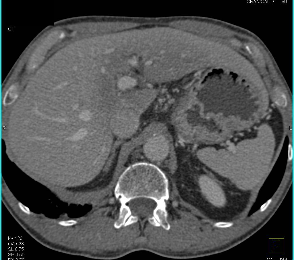 Pancreatic Cancer with Focal Fatty Infiltration Liver due to Radiation Therapy - CTisus CT Scan