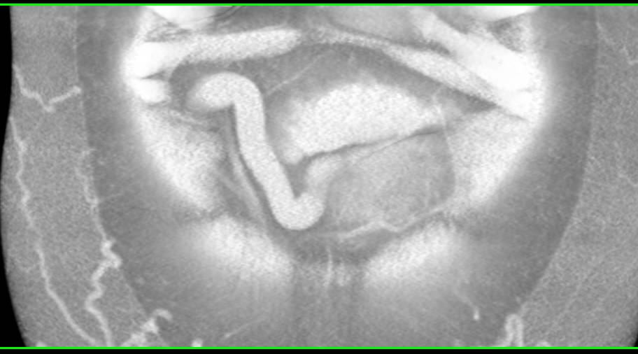 Portal Hypertension with Huge Subcutaneous Collaterals - CTisus CT Scan