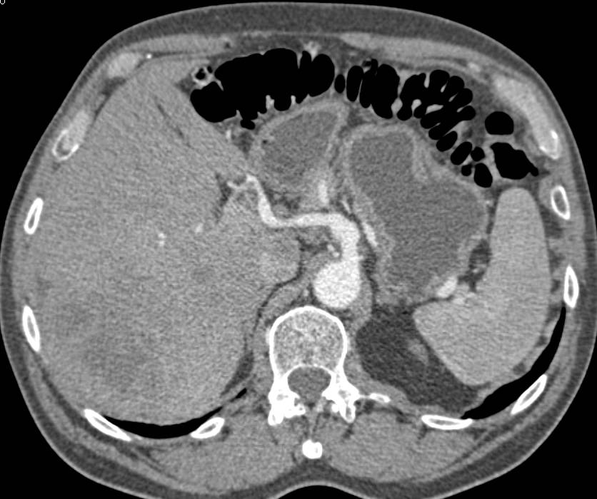 Hepatocellular Carcinoma (Hepatoma) - CTisus CT Scan