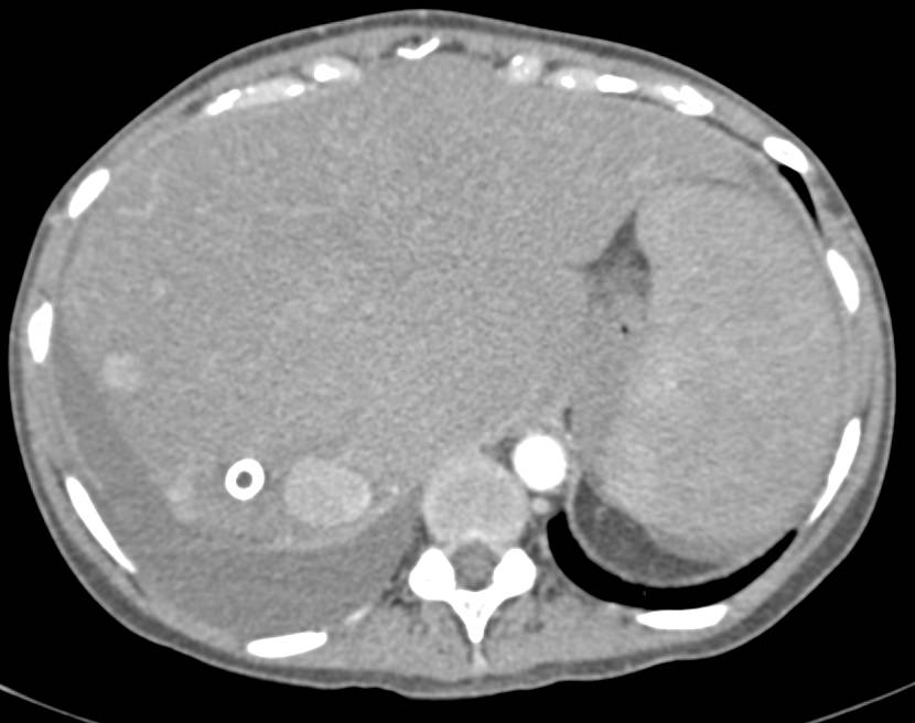 Cirrosis with Transjugular Intrahepatic Portosystemic Shunt (TIPS) Catheter with Enhancing Nodules Representing Regenerative Nodules - CTisus CT Scan