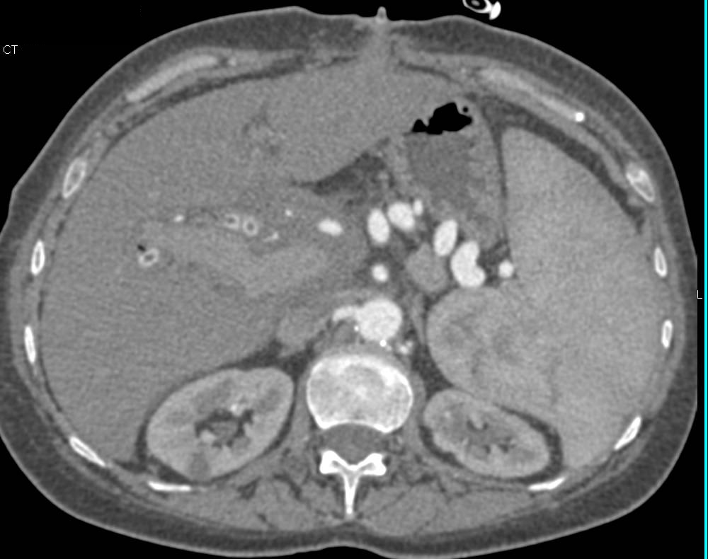 Cholangiocarcinoma Infiltrates Hilum of the Liver - CTisus CT Scan