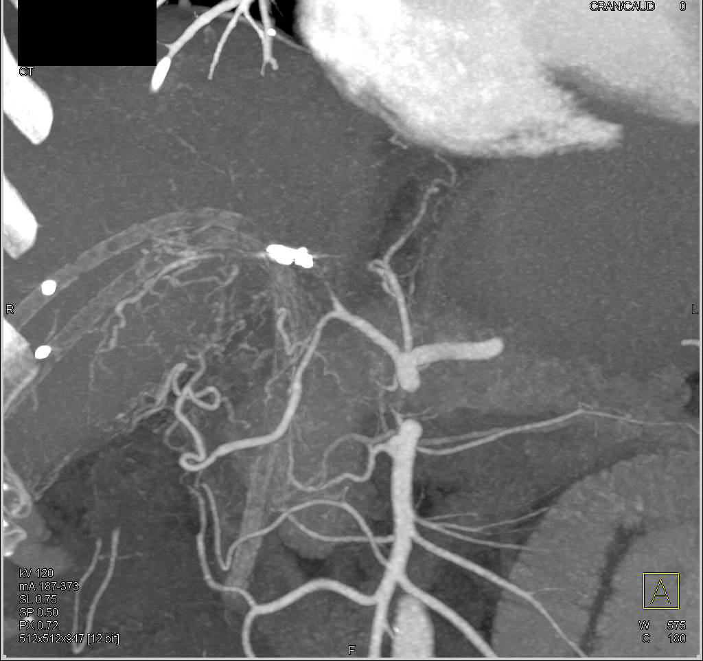 Invasive Cholangiocarcinoma seen on a CTA - CTisus CT Scan