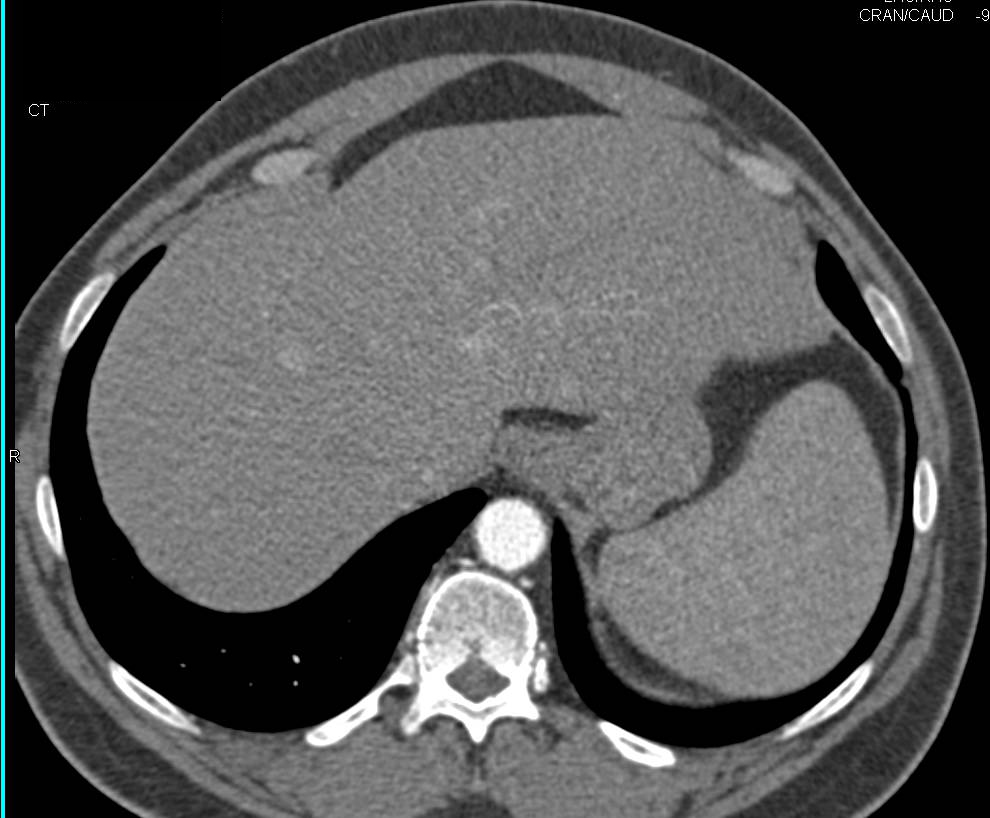 Subtle Vascular Liver Metastases Seen Best on MIP Imaging - CTisus CT Scan