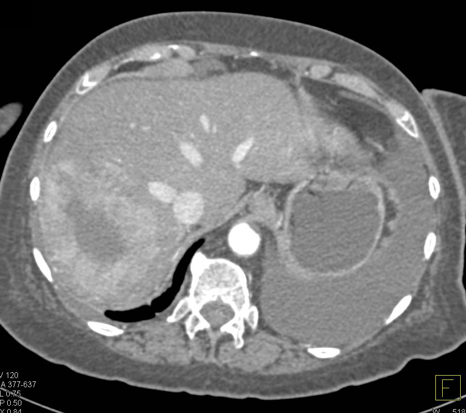 Hepatocellular Carcinoma (Hepatoma) in Multiple Phases - CTisus CT Scan