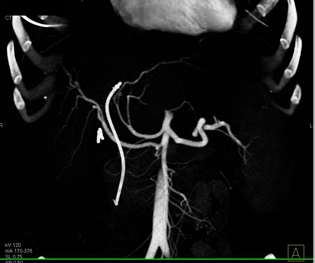 Cirrhosis with Portal Hypertension and Stent in Common Bile Duct (CBD) - CTisus CT Scan