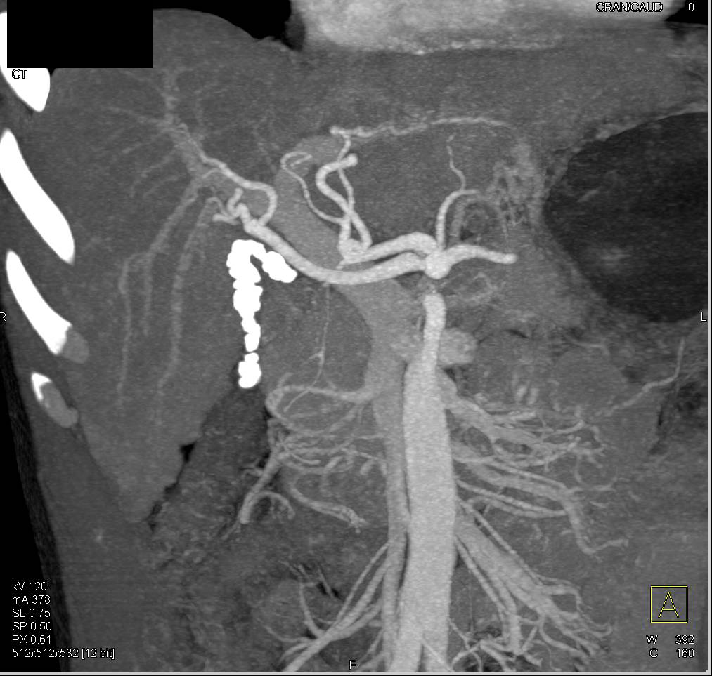 Cirrrhosis and Chronic Cholecystitis - CTisus CT Scan