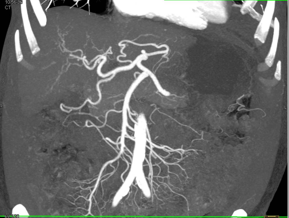 Cirrhotic Liver with Narrow Portal Vein and Varices - CTisus CT Scan