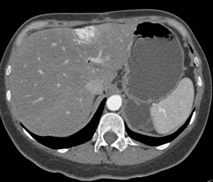 Focal Nodular Hyperplasia - CTisus CT Scan