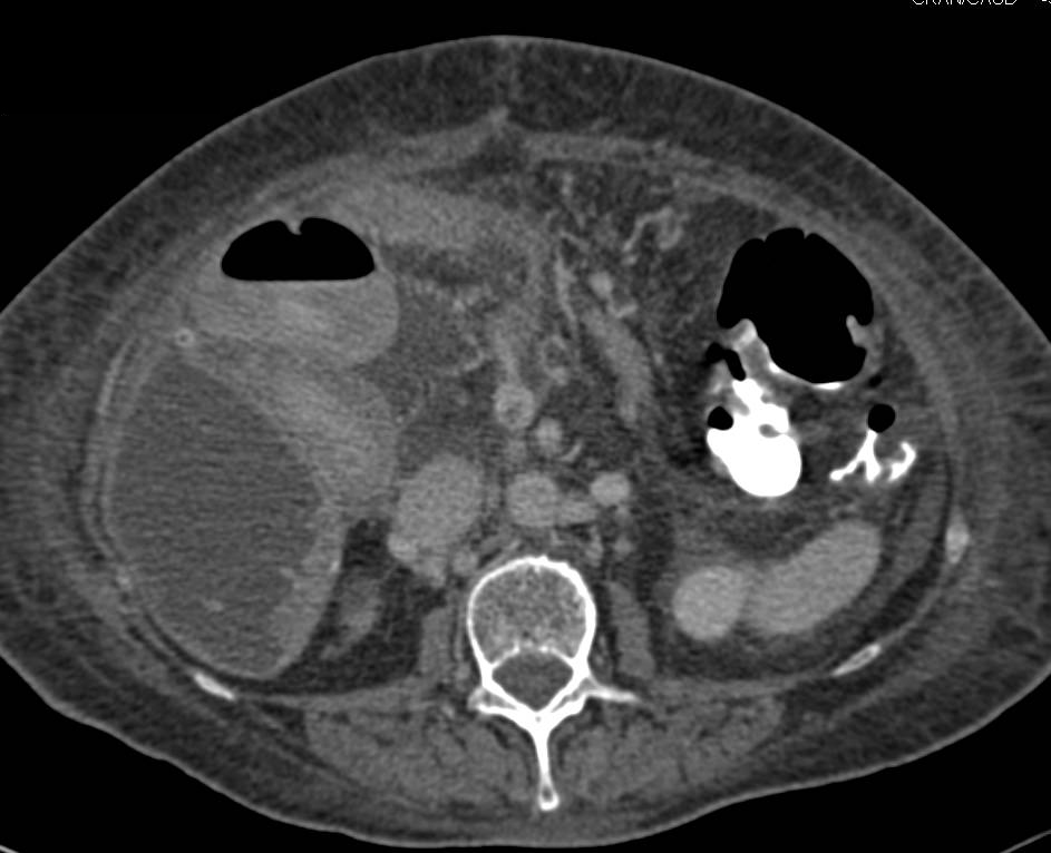 Hepatic Infarct - CTisus CT Scan