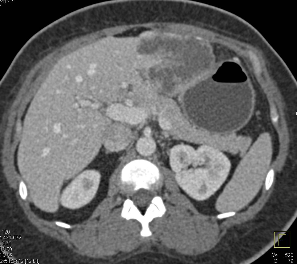 Hepatic Abscess - CTisus CT Scan