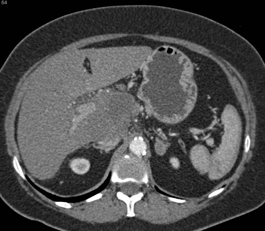 Cholangiocarcinoma Infiltrates Porta Hepatis with Encasement of the ...