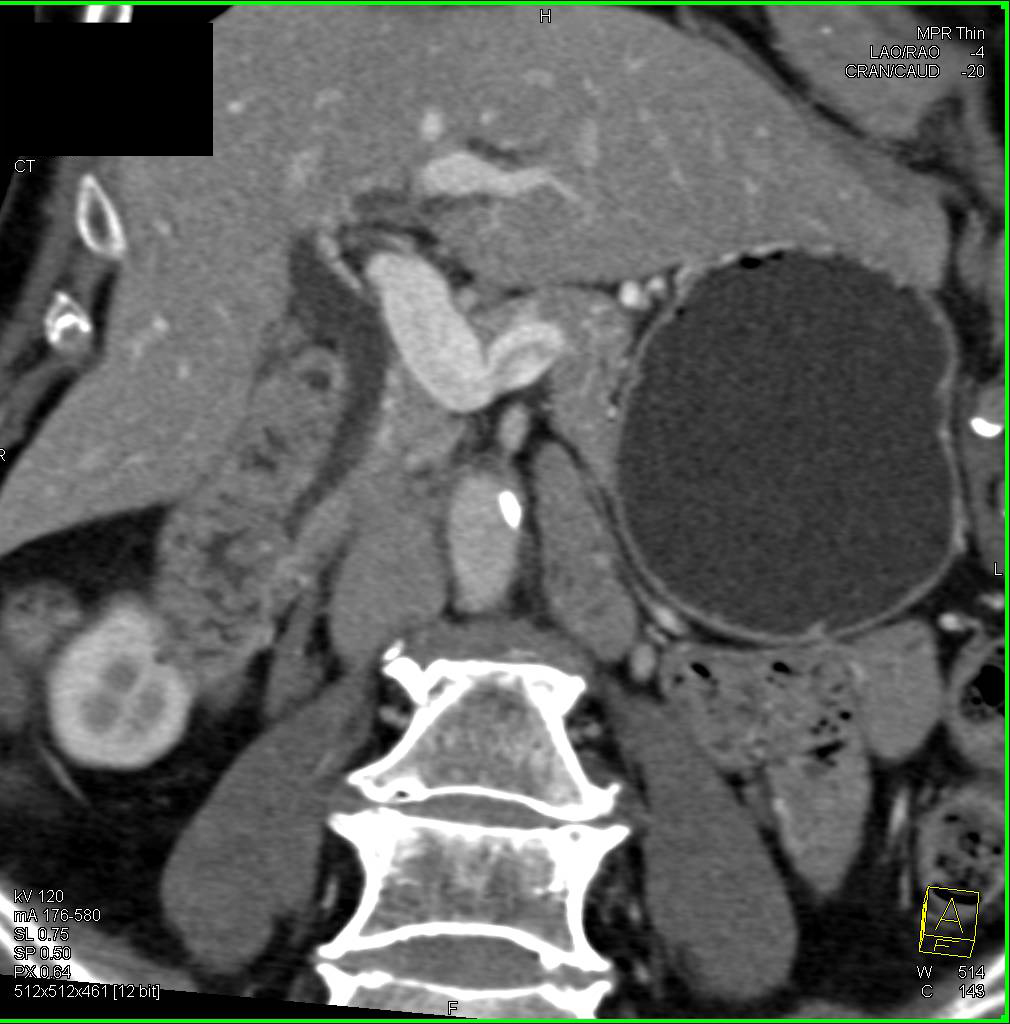 Common Duct Stricture - CTisus CT Scan