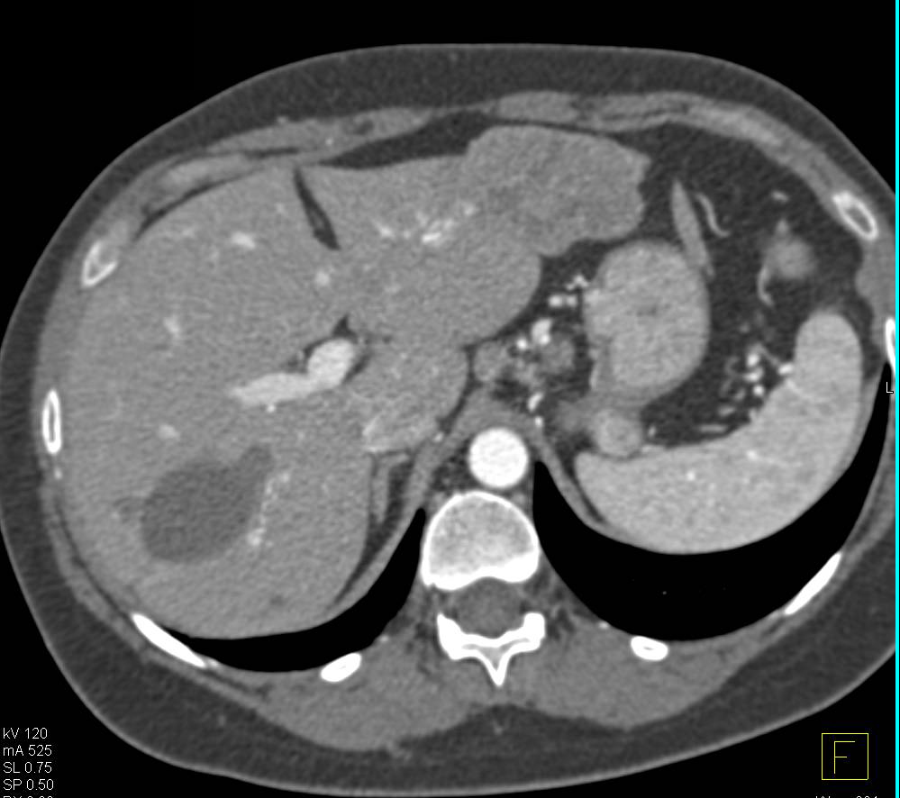 Metastatic Carcinoid Tumor to the Liver - CTisus CT Scan