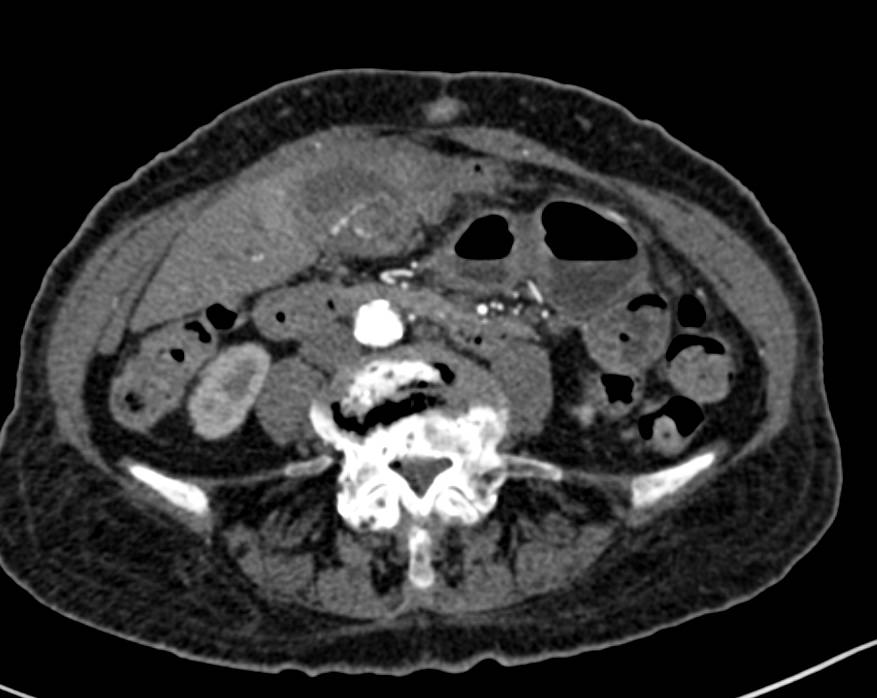 Invasive Gallbladder Cancer - CTisus CT Scan