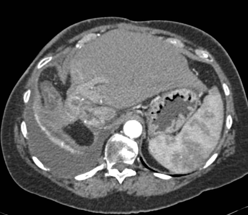 Recurrent Hepatocellular Carcinoma (Hepatoma) s/p Resection - CTisus CT Scan