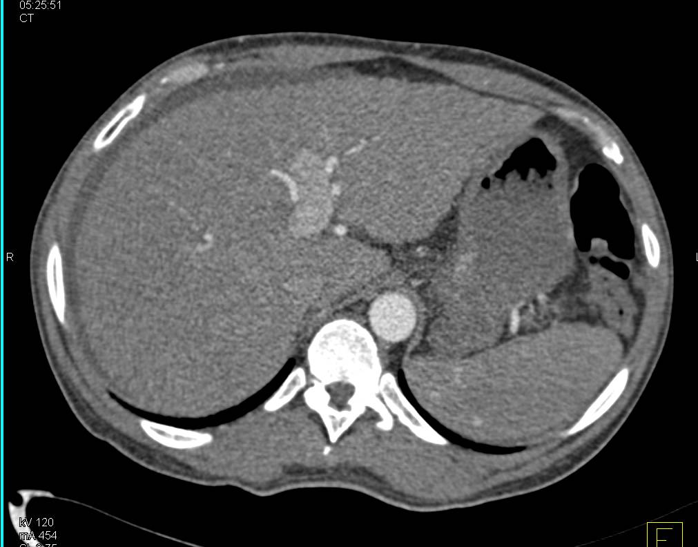 Cirrhosis with Beautiful Example of Recanalized Umbilical Vein with Drainage - CTisus CT Scan