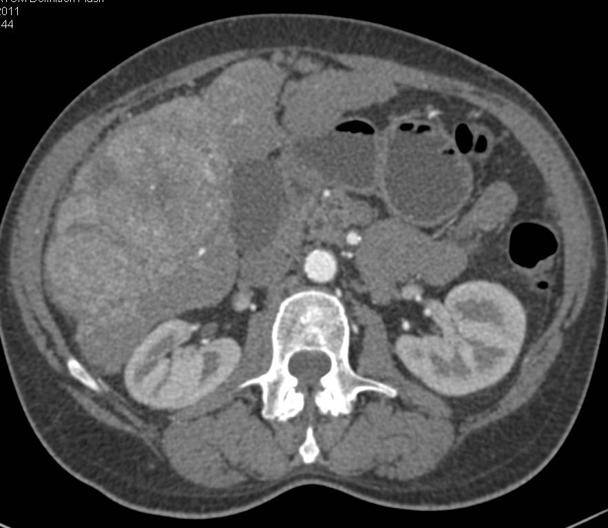 Hepatocellular Carcinoma (Hepatoma) with Pseudocapsule - CTisus CT Scan