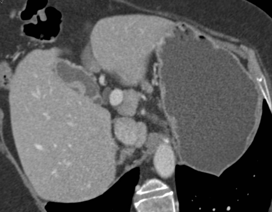 Polyp in the Gallbladder - Liver Case Studies - CTisus CT Scanning