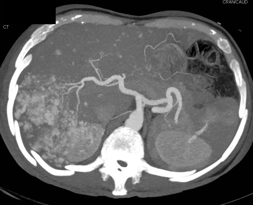 Incidental Giant Cavernous Hemangioma of the Liver - Liver Case Studies ...