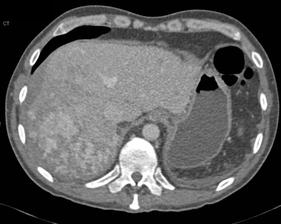 Hepatic Hemangioma - CTisus CT Scan