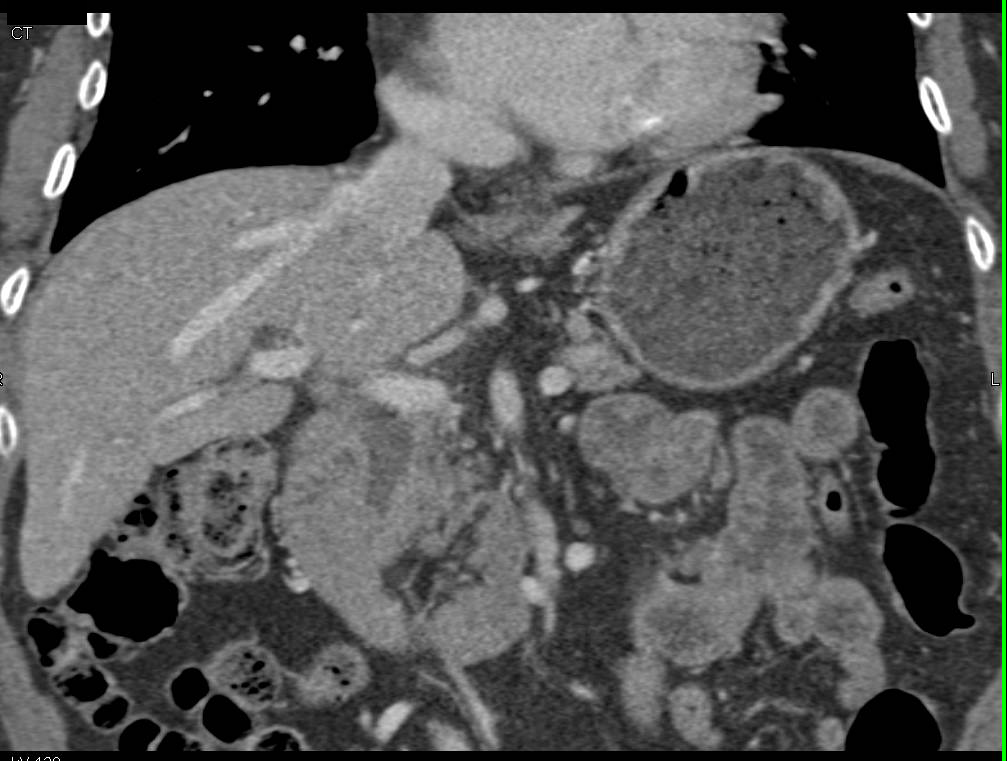 Ampullary Carcinoma - CTisus CT Scan