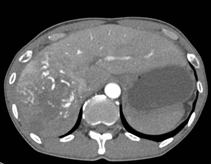 Hepatocellular Carcinoma (Hepatoma) with Pseudocapsule and Extension into the Inferior Vena Cava (IVC) - CTisus CT Scan