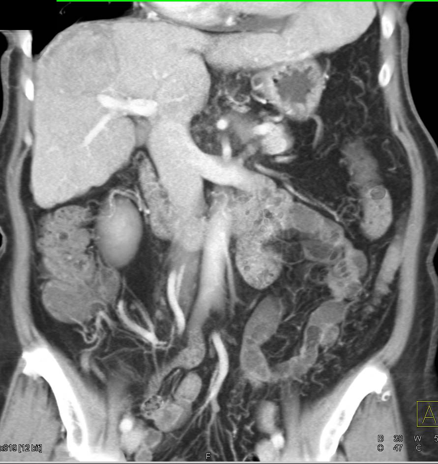 Hepatocellular Carcinoma (Hepatoma) with Pseudocapsule - CTisus CT Scan