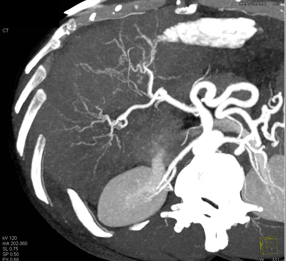 Cirrhosis of the Liver with Portal Hypertension and Varices - CTisus CT Scan