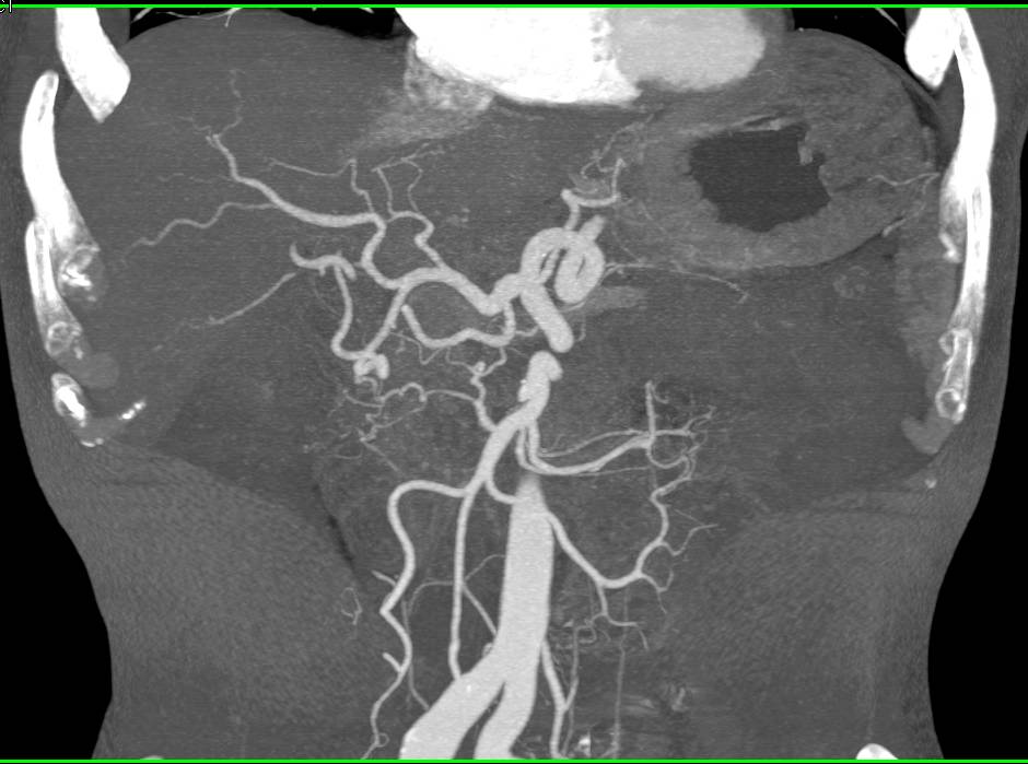 Pancreatic Adenocarcinoma Invades the Portal Vein - CTisus CT Scan