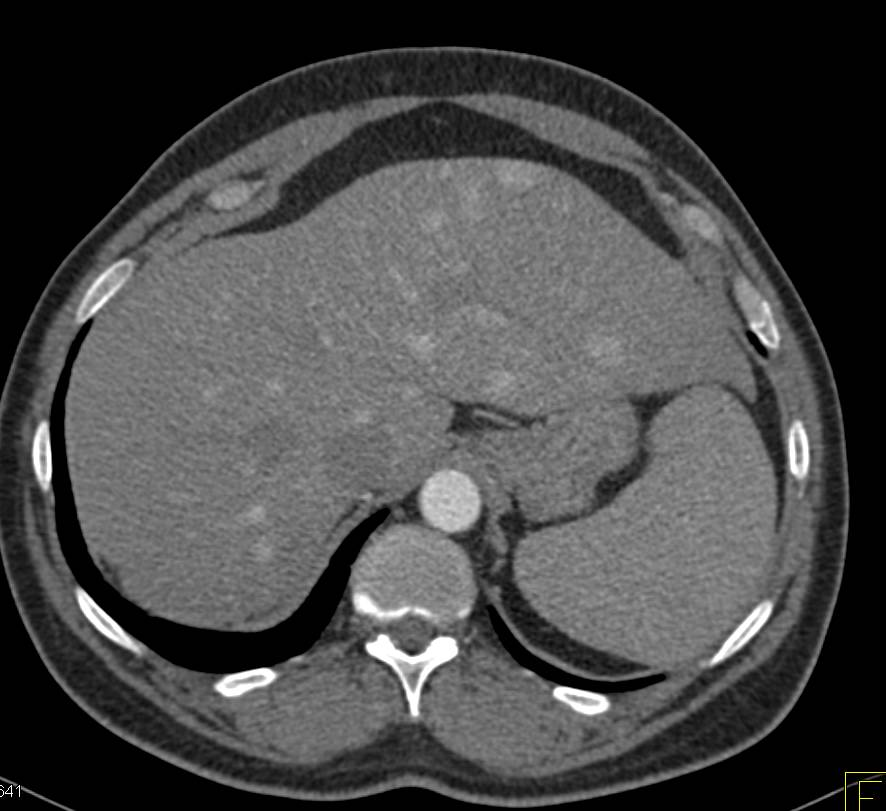 Hepatic Adenomatosis Simulates Vascular Liver Metastases - CTisus CT Scan