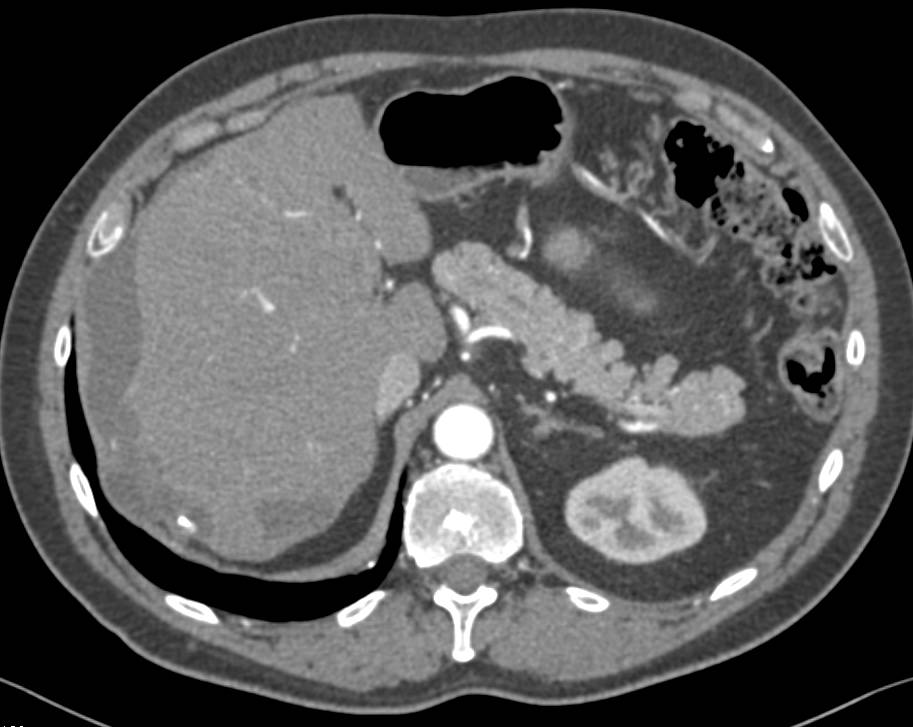 Pseudomyxoma Peritonei (PMP) - CTisus CT Scan