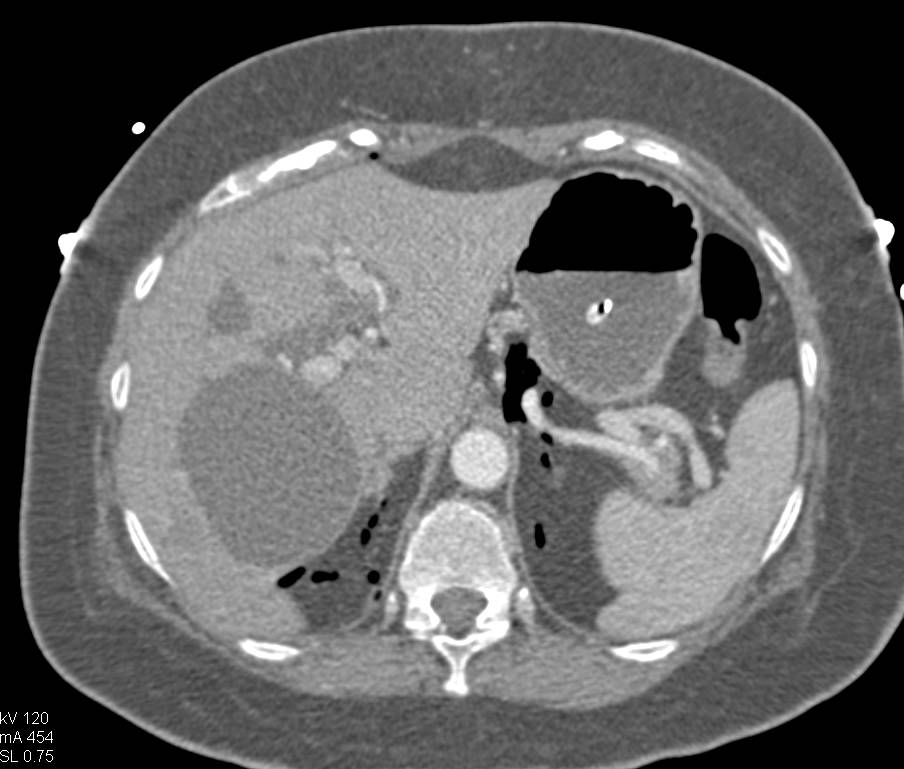 Impacted Stones in Distal Common Bile Duct with Biloma - CTisus CT Scan