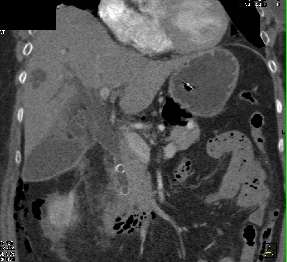 Multiple Common Duct Stones with Perforation s/p Endoscopic Retrograde Cholangiopancreatography (ERCP) - CTisus CT Scan