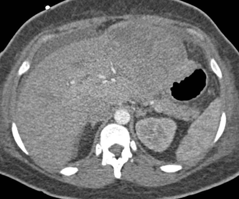 Hepatic Adenoma with Spontaneous Bleed - CTisus CT Scan