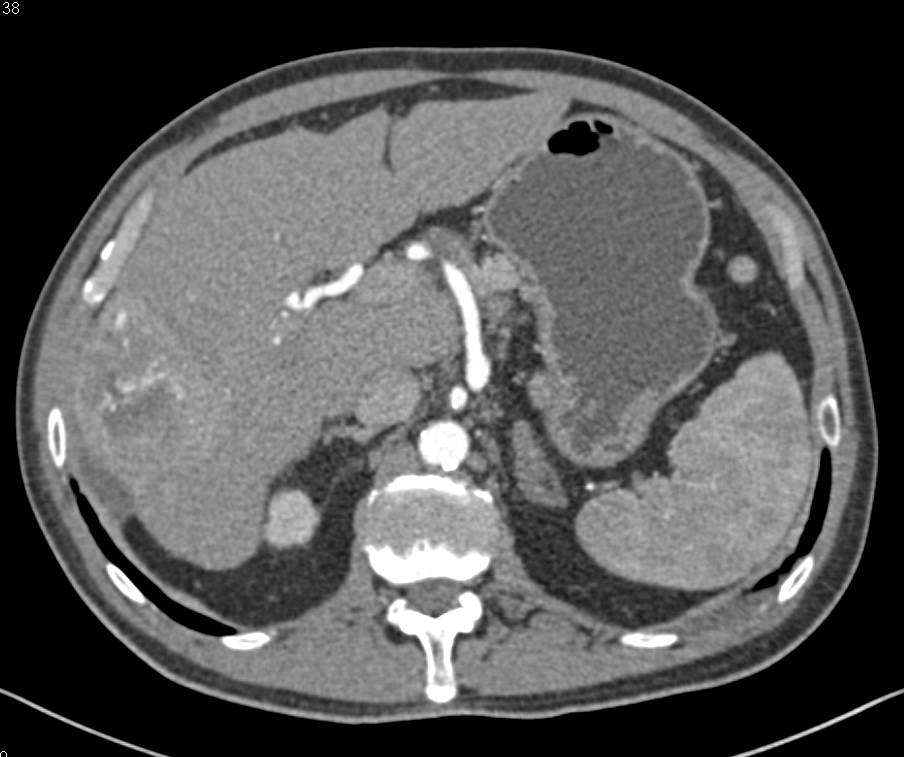 Hepatocellular Carcinoma (Hepatoma) with Neovascularity Arises in a Cirrhotic Liver - CTisus CT Scan