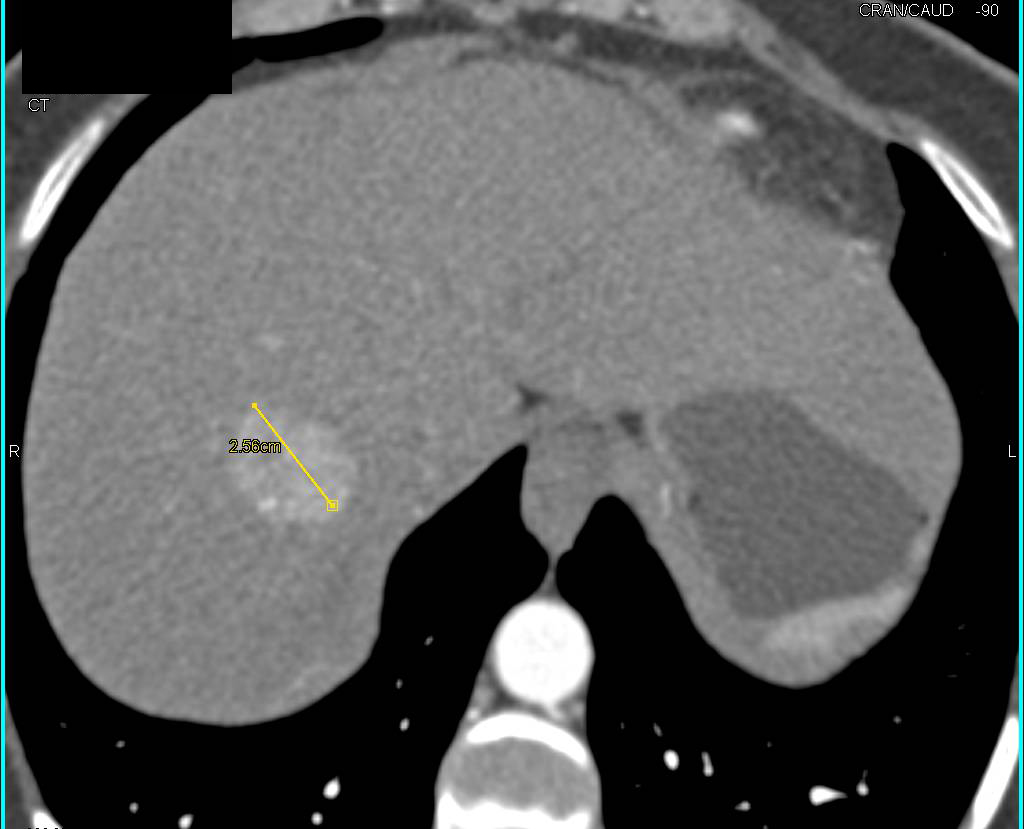 Focal Nodular Hyperplasia - CTisus CT Scan