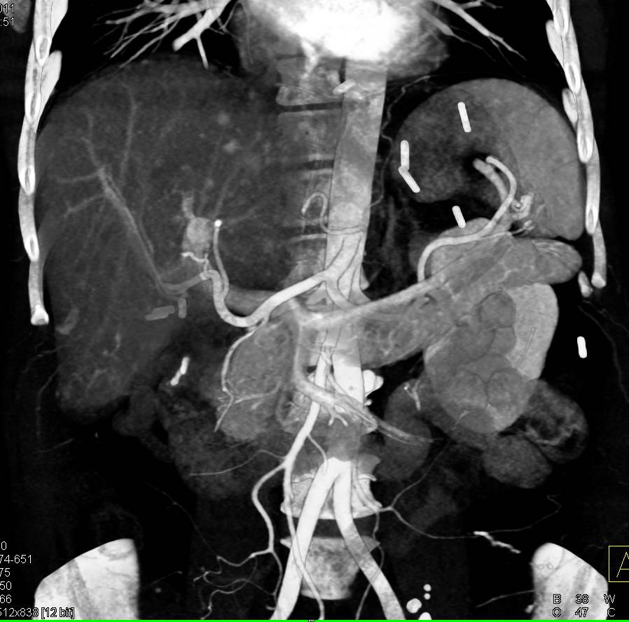 Carcinoid Tumor Metastatic to Liver Best Seen on MIP Images - CTisus CT Scan