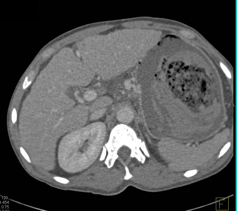 Hepatocellular Carcinoma (Hepatoma) in a Cirrhotic Liver - CTisus CT Scan