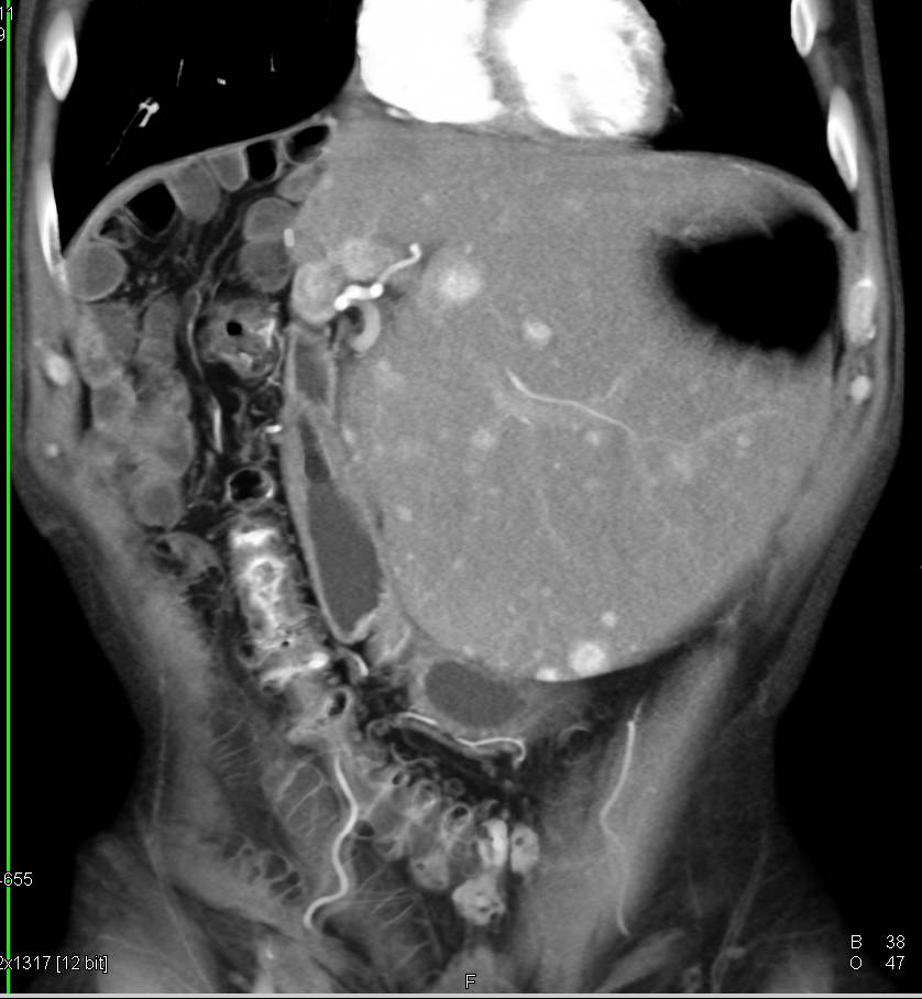 Recurrent Multifocal Hepatocellular Carcinoma (Hepatoma) in the Liver - CTisus CT Scan