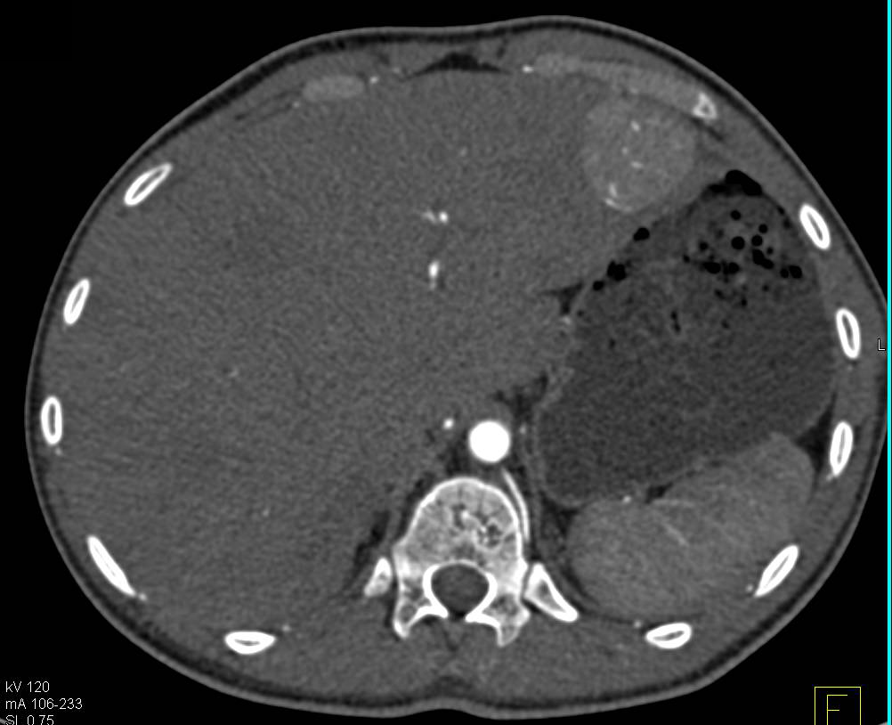 Hepatocellular Carcinoma (Hepatoma) - CTisus CT Scan