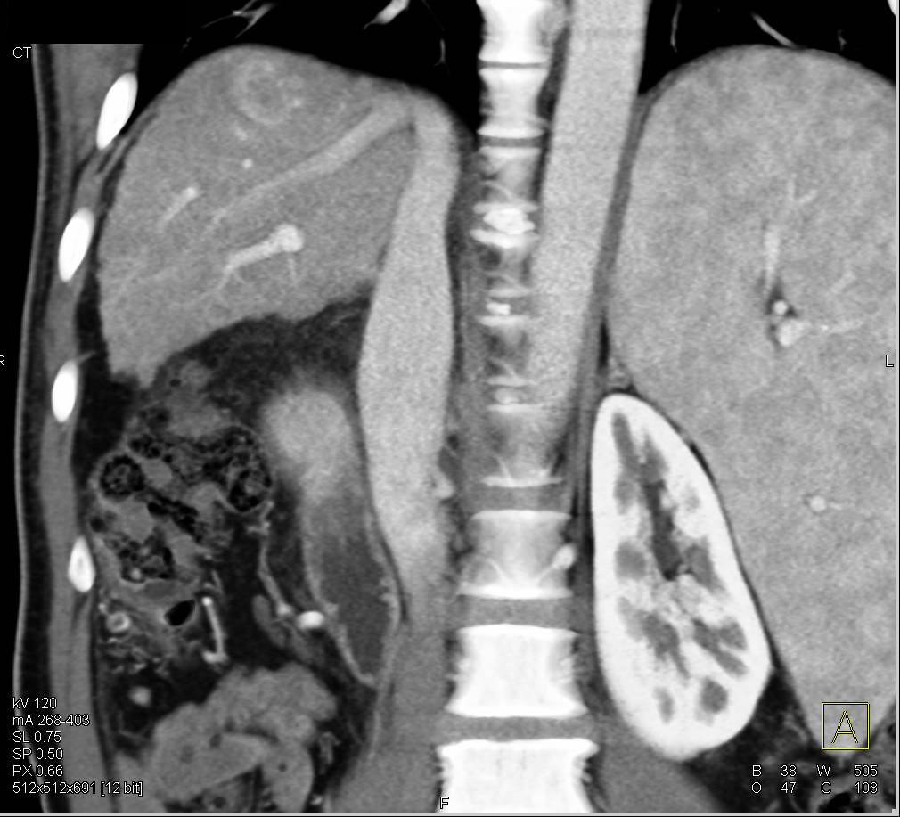 Metastatic Renal Cell Carcinoma to the Liver - CTisus CT Scan