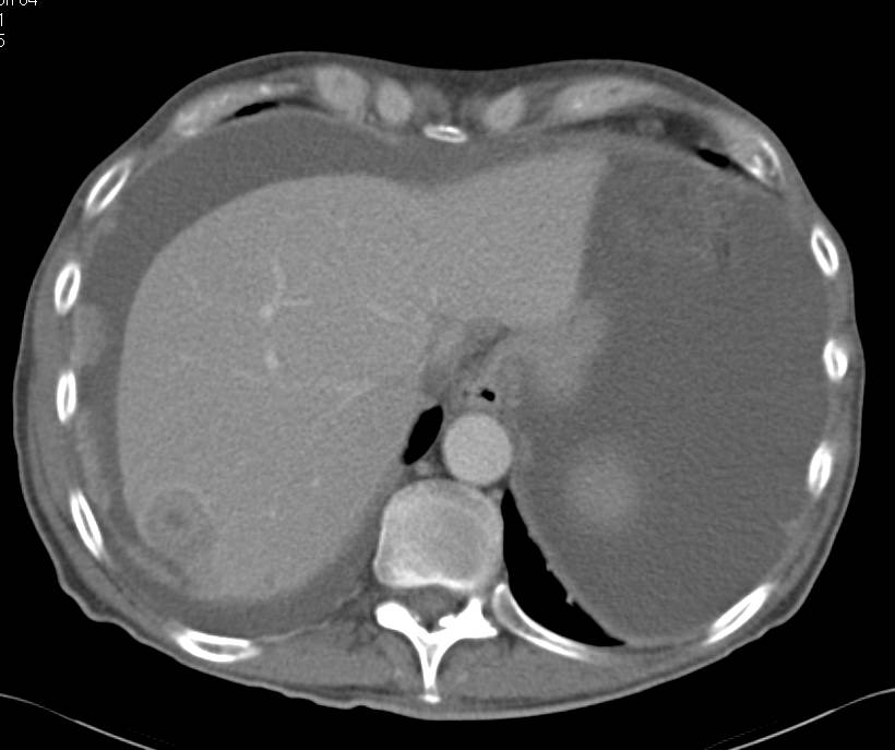 Bullseye Metastasis to Liver from Melanoma - CTisus CT Scan