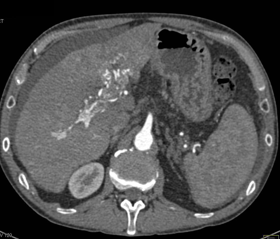 Hepatocellular Carcinoma (Hepatoma) in Cirrhotic Liver Invades the Portal Vein with Arteriovenous (AV) Shunting - CTisus CT Scan